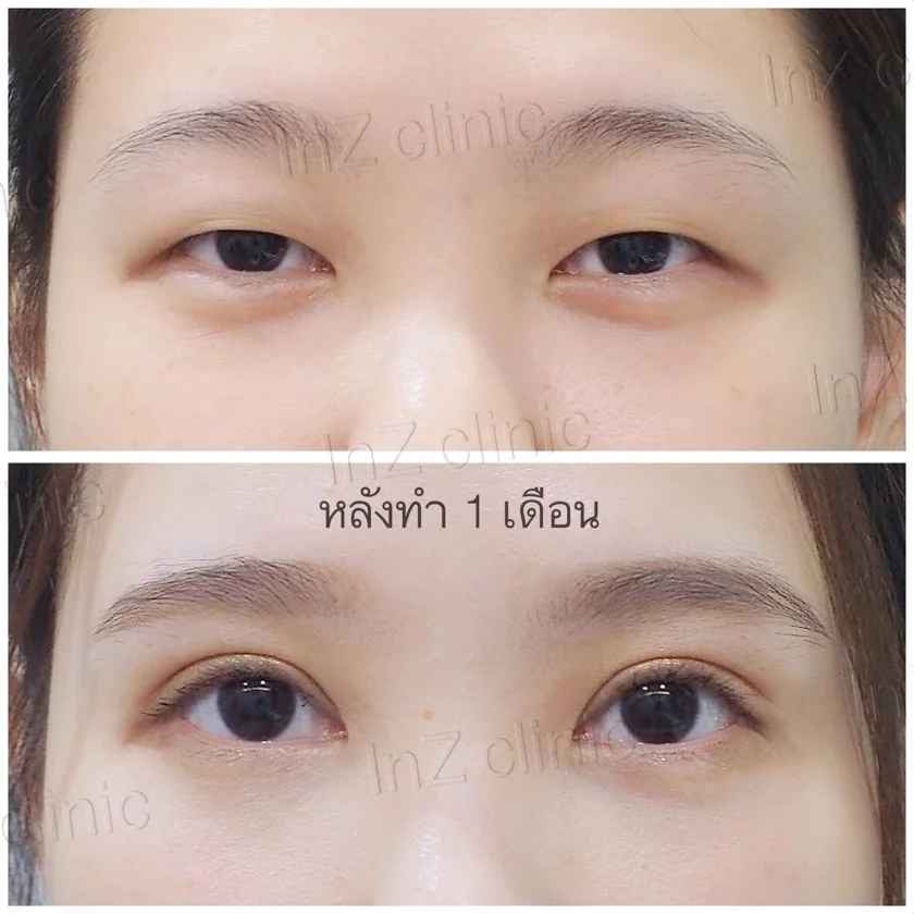 ทำตาสองชั้นที่ไหนดี_ทำที่_inz_clinic_เทคนิค_Big_eye_surgery