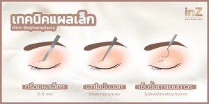 ทำตาสองชั้นที่ไหนดี_เทคนิคแผลเล็ก