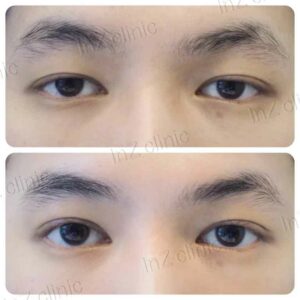 ทำตาสองชั้นผู้ชาย
