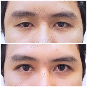 ทำตาสองชั้นผู้ชาย