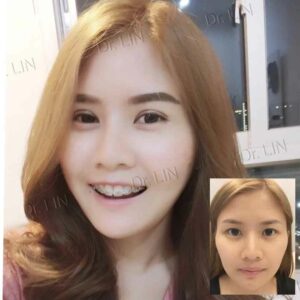 ตาสองชั้นแผลเล็ก