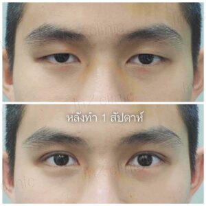 ตาสองชั้นแผลเล็ก