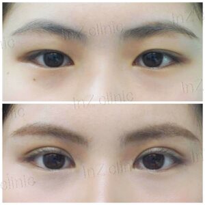 ตาสองชั้นแผลเล็ก