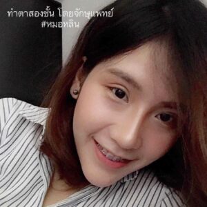ตาสองชั้นแผลเล็ก