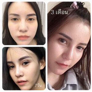 ตาสองชั้นแผลเล็ก