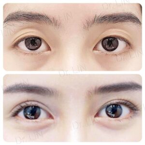 ตาสองชั้นแผลเล็ก
