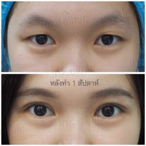 ตาสองชั้นแผลเล็ก