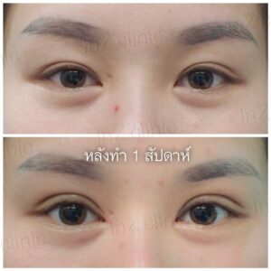 ตาสองชั้นแผลเล็ก