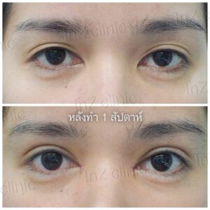 ตาสองชั้นแผลเล็ก