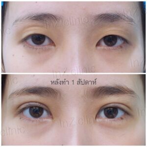 ตาสองชั้นแผลเล็ก