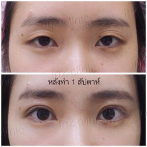 ตาสองชั้นแผลเล็ก