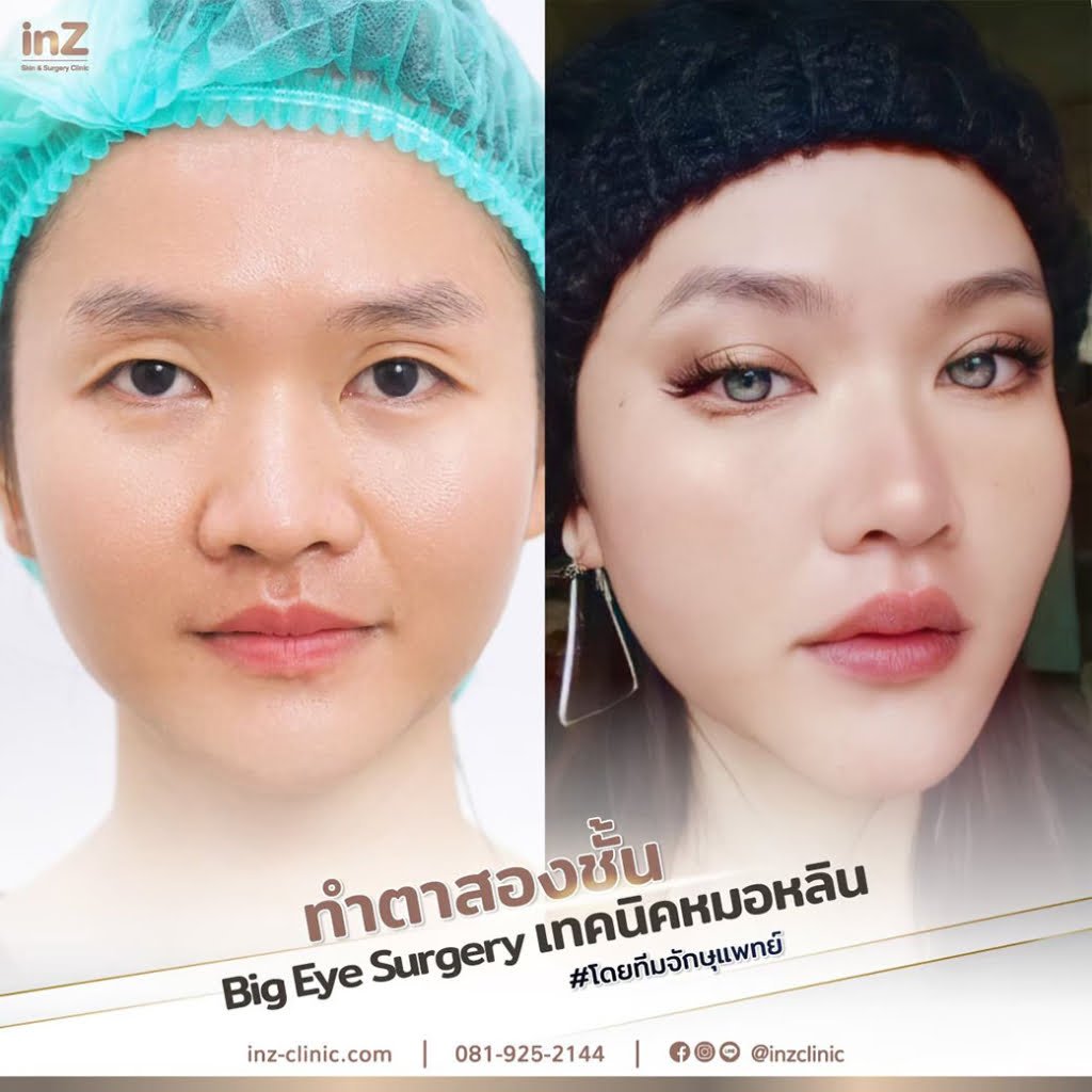 รวมรีวิวทำตากล้ามเนื้อตาอ่อนแรง 03