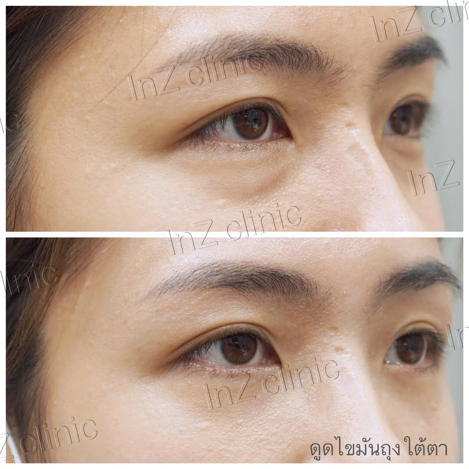 รีวิว ผ่าตัดดถุงใต้ตา04