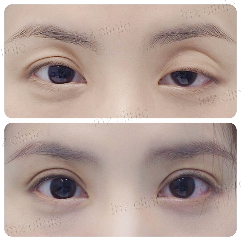 รีวิว วิธีทำตา ปัญหาตาไม่เท่ากัน 02
