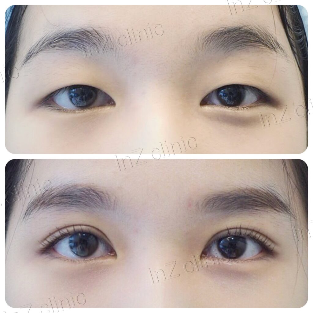รีวิว วิธีทำตา ปัญหาตาชั้นเดียว  02