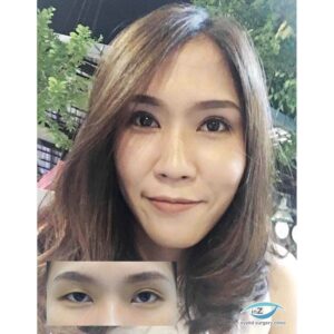ศัลยกรรมตาโต เย็บกล้ามเนื้อตา