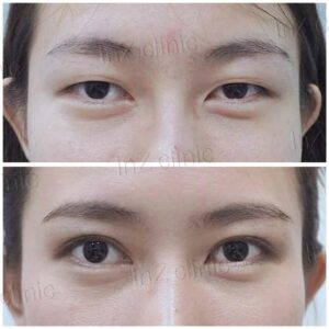 ศัลยกรรมตาโต เย็บกล้ามเนื้อตา