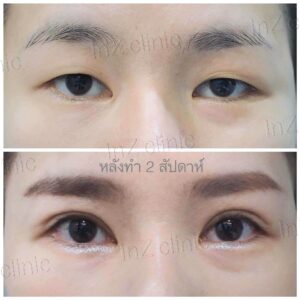 ศัลยกรรมตาโต เย็บกล้ามเนื้อตา