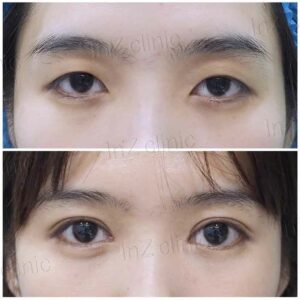 ศัลยกรรมตาโต เย็บกล้ามเนื้อตา