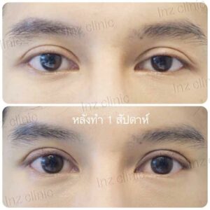 ศัลยกรรมตาโต เย็บกล้ามเนื้อตา