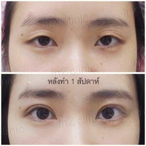 ศัลยกรรมตาโต เย็บกล้ามเนื้อตา