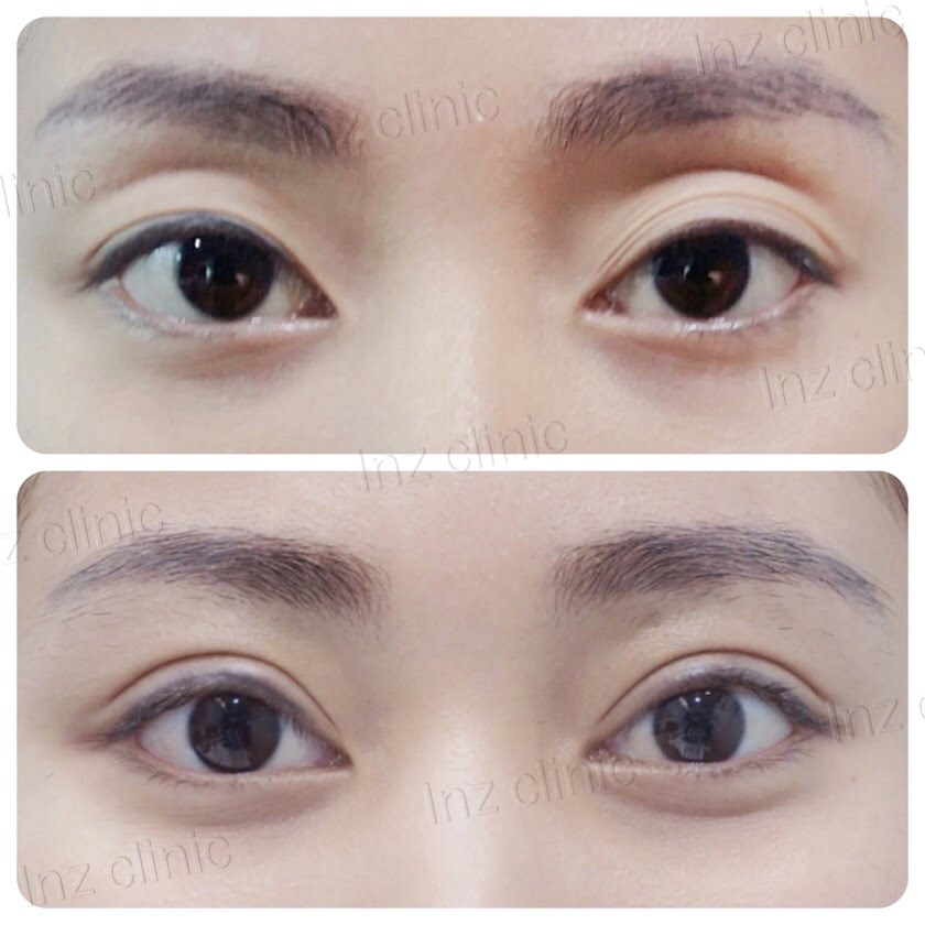 รีวิวตาสองชั้นเบ้าตาลึก_หมอหลิน_01