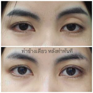 เบ้าตาลึก