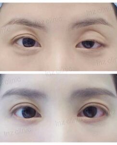 เบ้าตาลึก