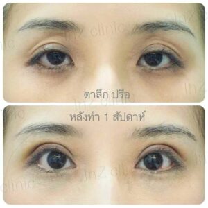 เบ้าตาลึก