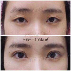 เบ้าตาลึก