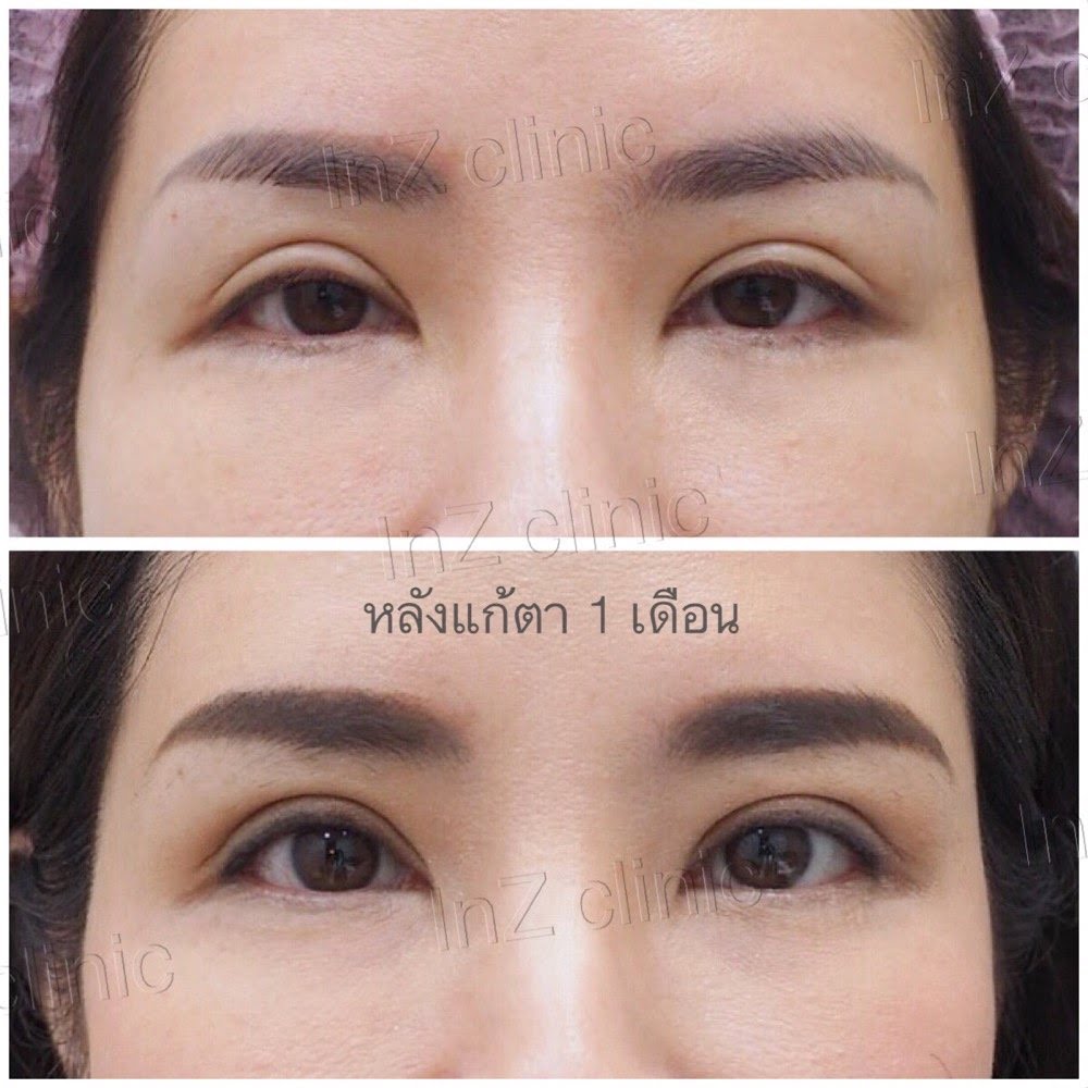 แก้ตาสองชั้น ที่เคยทำมาก่อน_04
