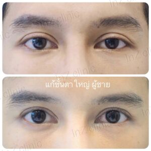 งานแก้ตาสองชั้นที่เคยทำมาก่อน
