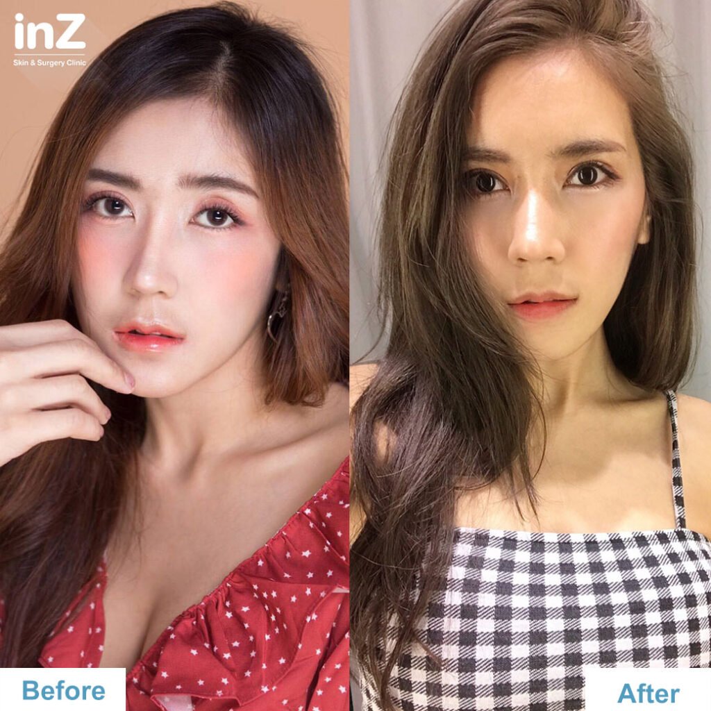 แก้ไขทำตาสองชั้น_คุณชา_Big_eye_surgery02