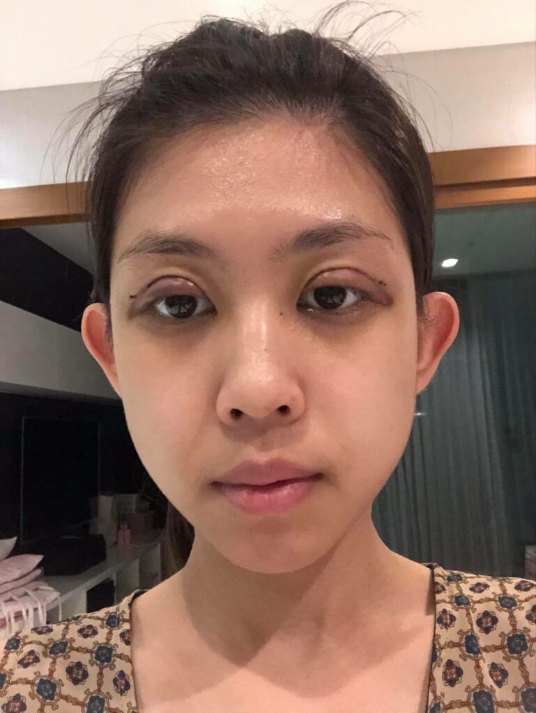 รีวิวทำตาสองชั้น_คุณแบม_Big_eye_surgery04
