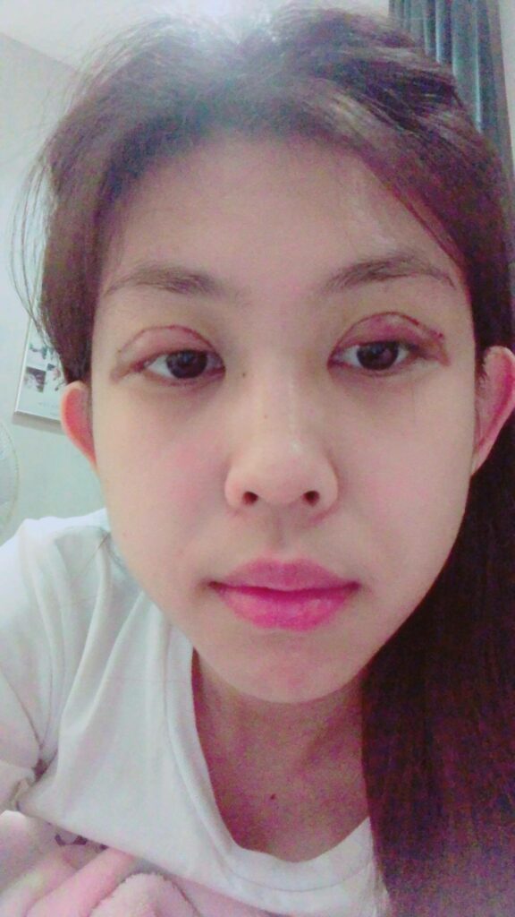 รีวิวทำตาสองชั้น_คุณแบม_Big_eye_surgery05