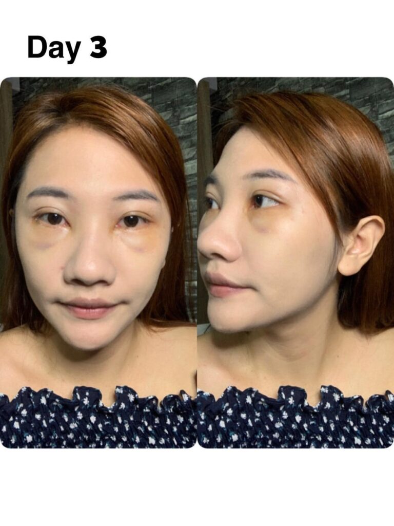 รีวิวทำตาสองชั้น_คุณเค้ก_ดูดไขมันกำจัดถุงใต้ตา05
