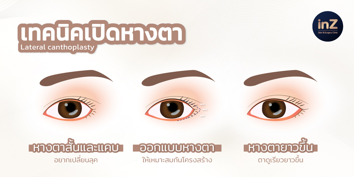 เปิดหางตาสไตล์เกาหลี ด้วยเทคนิคพิเศษของ inZ Clinic