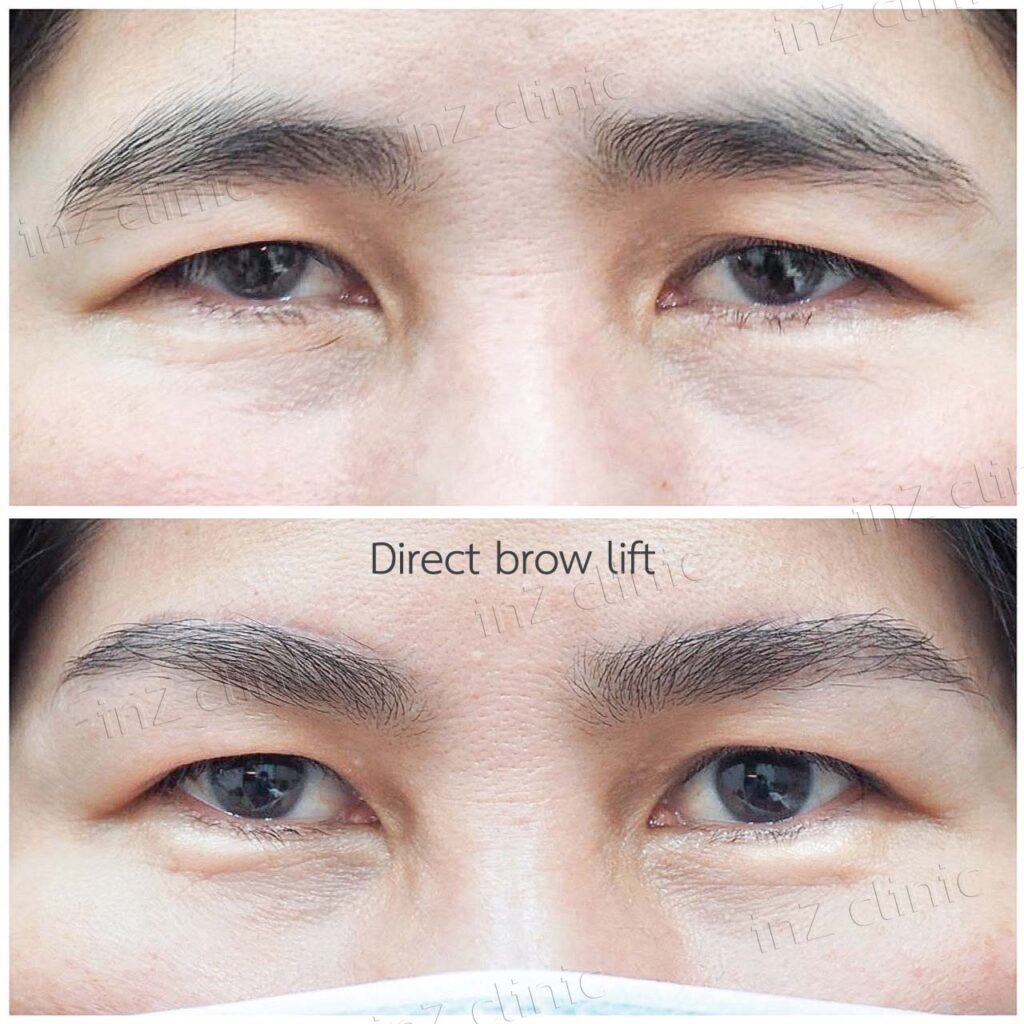 ทำตา Foxy eyes ด้วยการยกคิ้ว inz clinic 02
