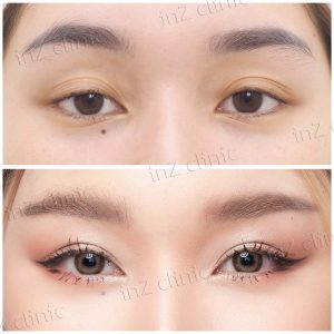 รีวิวแก้ไขตาปรือ กล้ามเนื้ออ่อนแรง Upper-Blepharoplasty-42