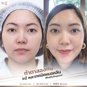 รีวิวแก้ไขตาปรือ กล้ามเนื้ออ่อนแรง Upper-Blepharoplasty-43