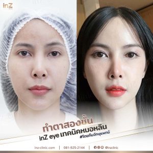 รีวิวแก้ไขตาปรือ กล้ามเนื้ออ่อนแรง Upper-Blepharoplasty-44