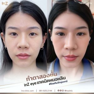 รีวิวแก้ไขตาปรือ กล้ามเนื้ออ่อนแรง Upper-Blepharoplasty-45