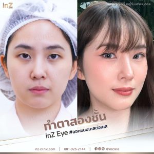 รีวิวแก้ไขตาปรือ กล้ามเนื้ออ่อนแรง Upper-Blepharoplasty-46