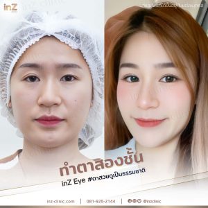 รีวิวแก้ไขตาปรือ กล้ามเนื้ออ่อนแรง Upper-Blepharoplasty-47