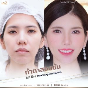 รีวิวแก้ไขตาปรือ กล้ามเนื้ออ่อนแรง Upper-Blepharoplasty-48