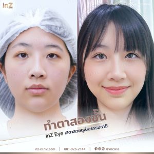 รีวิวแก้ไขตาปรือ กล้ามเนื้ออ่อนแรง Upper-Blepharoplasty-49