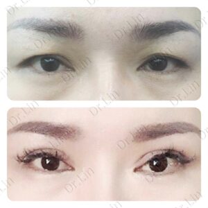 ทำตาสองชั้น_แก้หนังตาตก_04