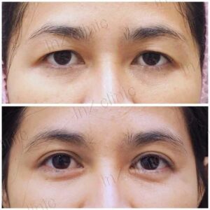ทำตาสองชั้น_แก้หนังตาตก_100