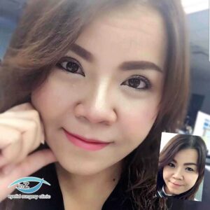 ทำตาสองชั้น_แก้หนังตาตก_23