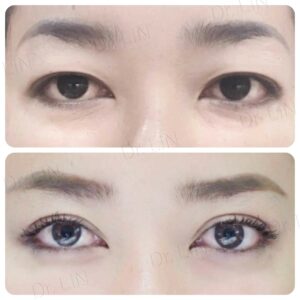 ทำตาสองชั้น_แก้หนังตาตก_26